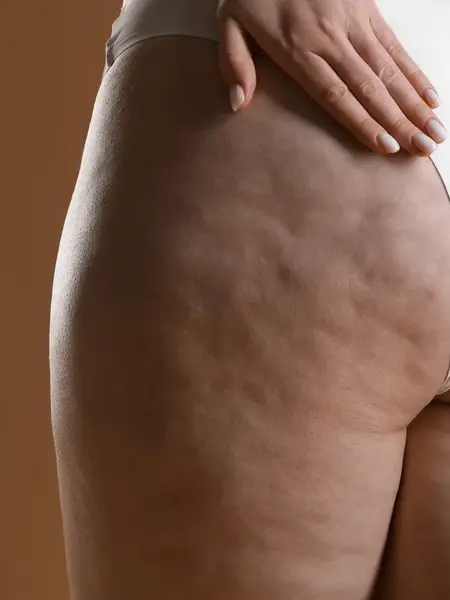 Cellulite